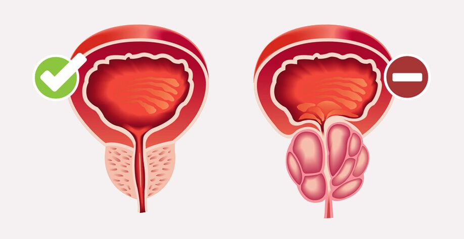 Weiprost normalizira velikost in delovanje prostate