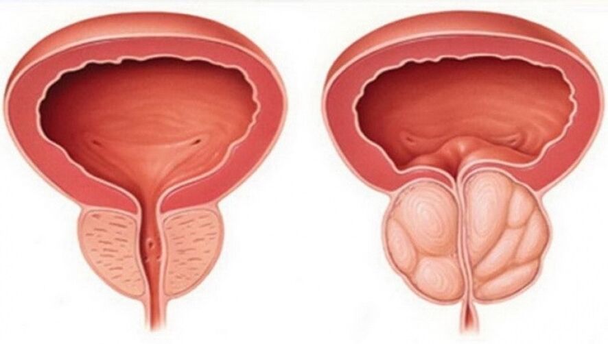 zdrava in vneta prostata s prostatitisom