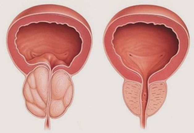 zdrava in vneta prostata s prostatitisom