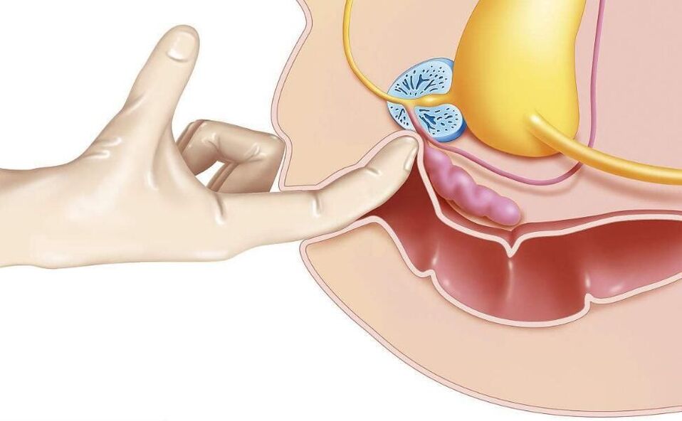 Masaža prostate za zdravljenje prostatitisa